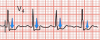 Imagen de un ECG