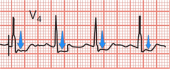 Imagen de un ECG